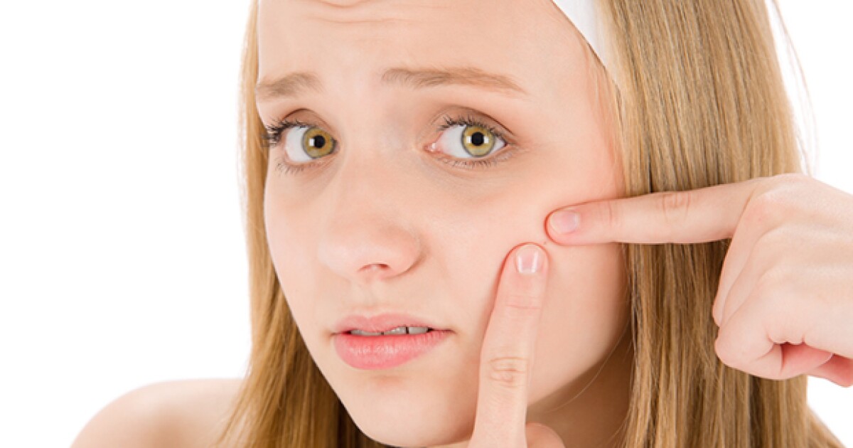 que alimentos producen el acne juvenil